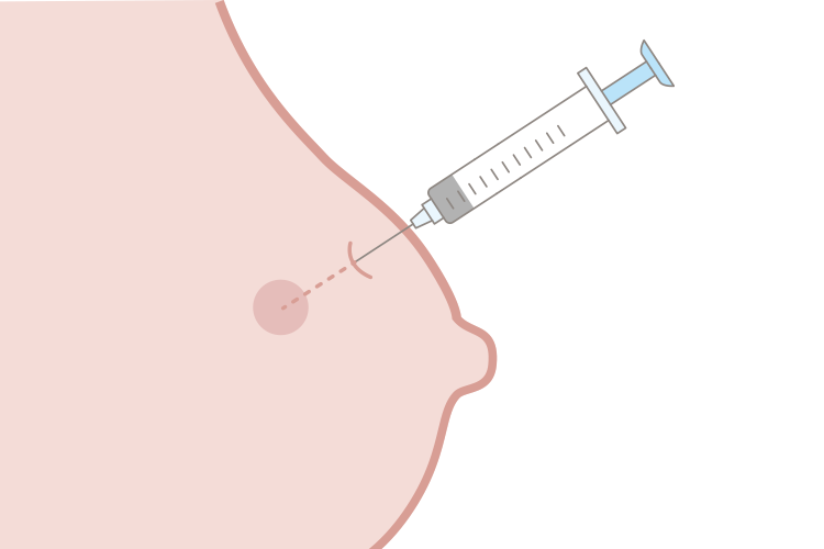 注射器で細胞を採取するイメージ画像