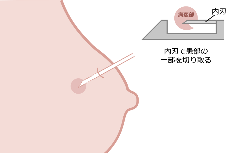 針の内刃で患部の一部を切り取るイメージ画像